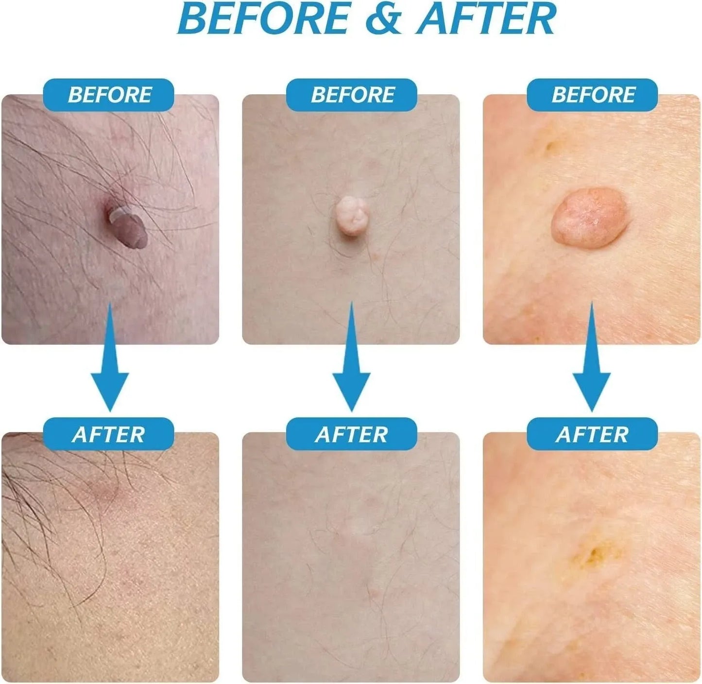 Skin-Tag Remover Double Headed Pen Set